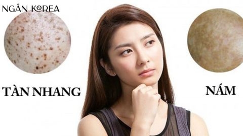 Nám và tàn nhang khác nhau ở đâu?