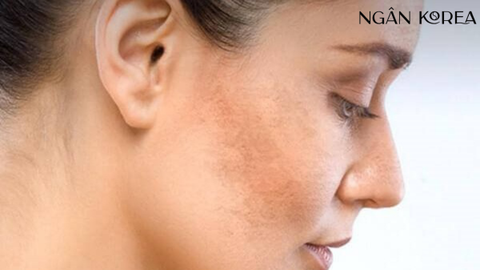 Nám kháng trị và những điều cần biết?