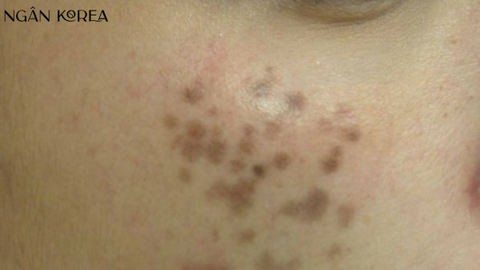 Nám chân đinh là gì? Nguyên nhân và cách điều trị