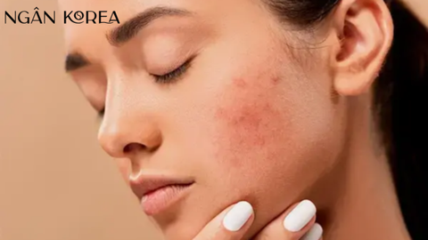 Dùng Niacinamide bị lên mụn? Nguyên nhân và cách xử lý