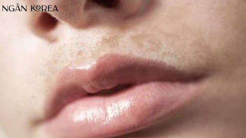 Nám râu là gì? Nám râu làm sao hết? Cách điều trị