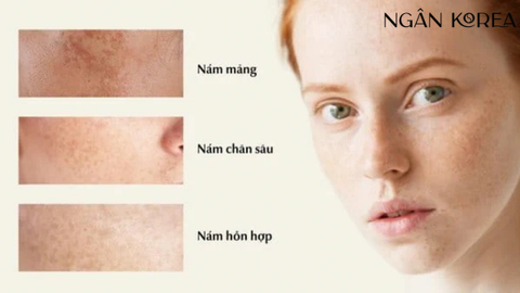 Nám má là gì và cách trị nám 2 bên gò má hiệu quả