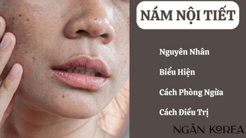 Nám nội tiết là gì? Cách điều trị nám nội tiết tại nhà mà bạn nên biết?