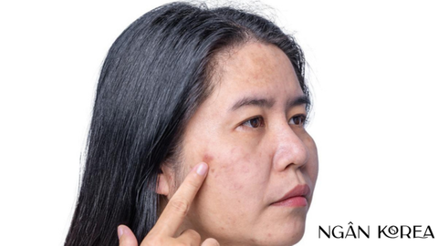 Nám tàn nhang là gì và những điều cần biết?