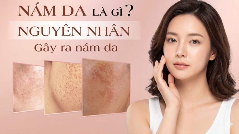 Nám da là gì? Dấu hiệu, nguyên nhân và cách trị nám da hiệu quả?
